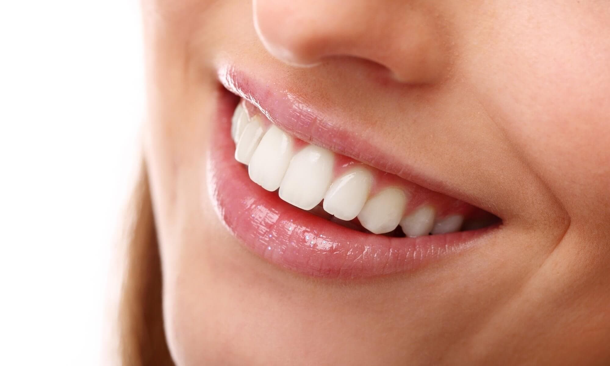 Veneers